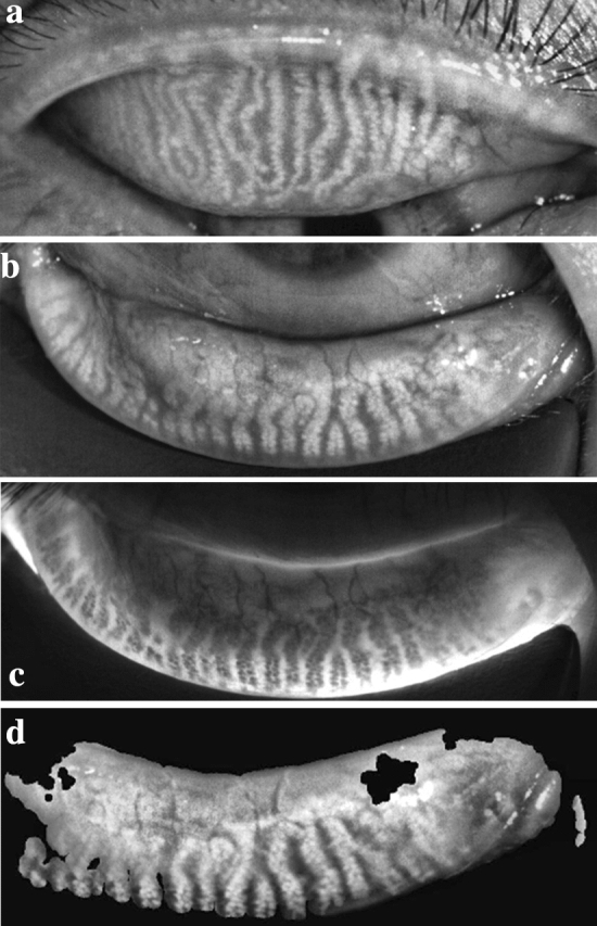 Meibography images of a patient with obstructive meibomian gland dysfunction, showing gland distortion and loss